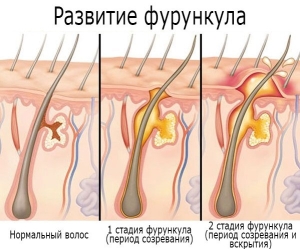 Фурункул на обличчі і шиї: фото, як лікувати чиряк