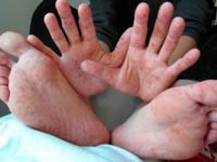 Пітниця на обличчі у немовлят, новонароджених: фото, лікування