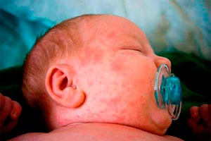 Пітниця на обличчі у немовлят, новонароджених: фото, лікування