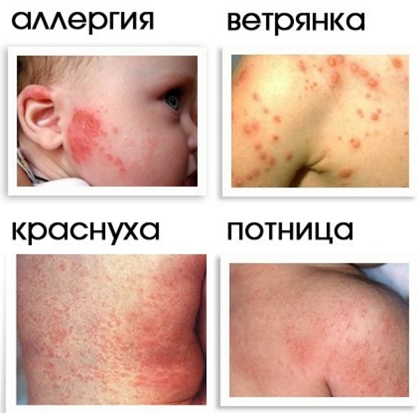 Як відрізнити потнічкі від алергії у немовлят