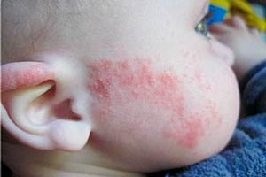 Як відрізнити потнічкі від алергії у немовлят