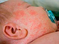 Чим лікувати екзему на обличчі, голові в волоссі, шиї, вухах