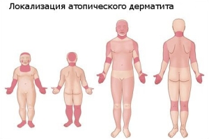 Симптоми і лікування атопічного дерматиту у немовлят, дітей і дорослих ( фото )