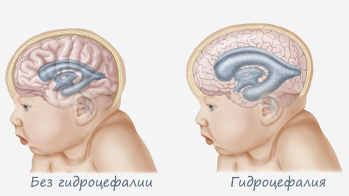 Нейросонографія новонародженого: призначення і розшифровка результатів