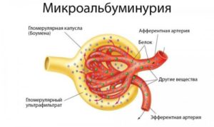 Аналіз на мікроальбумінурію (МАУ)