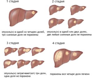 Симптоми і стадії раку печінки: прогноз на життя