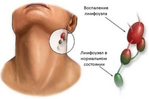 Процедура ультразвукової діагностики лімфатичних вузлів