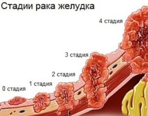 Симптоматика та лікування раку шлунка 4 стадії