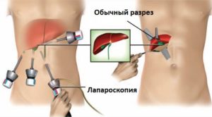 Кіста печінки: чим небезпечна і як лікувати? Кіста печінки: чим небезпечна і як лікувати?