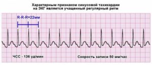 Чим небезпечна тахікардія і як її лікувати?