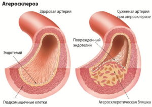 Причини, симптоми, лікування і профілактика підвищеного холестерину