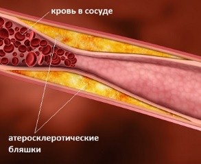 Причини, симптоми, лікування і профілактика підвищеного холестерину
