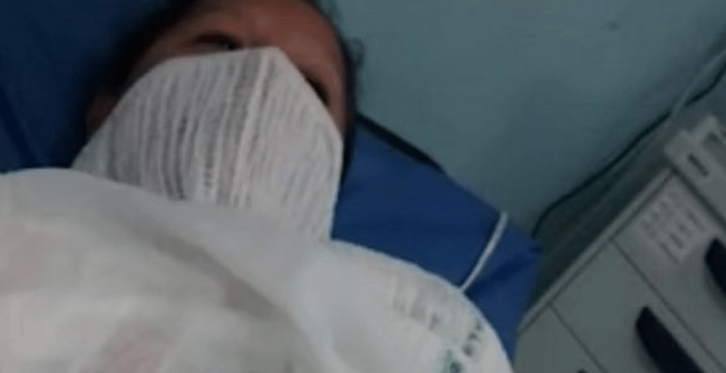 Лікарі на 3 тижні замотали руку жінки в риб'ячу луску. Знявши її, фахівці закричали
