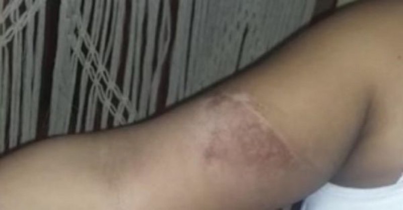 Лікарі на 3 тижні замотали руку жінки в риб'ячу луску. Знявши її, фахівці закричали