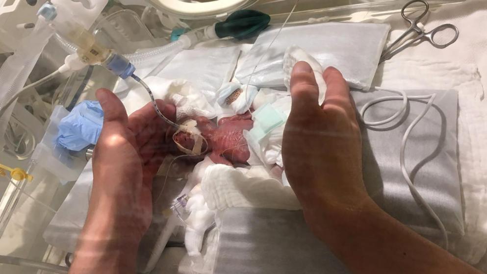 Мамо, не змікаючі очей, годувать малюка розміром з Цибулини змоченімі в молоці тампонами
